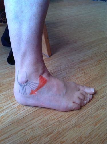 ankle sprained sprain support aid temporary bone outside outer side injury area walking joint ligament figure ligaments swell painful turns